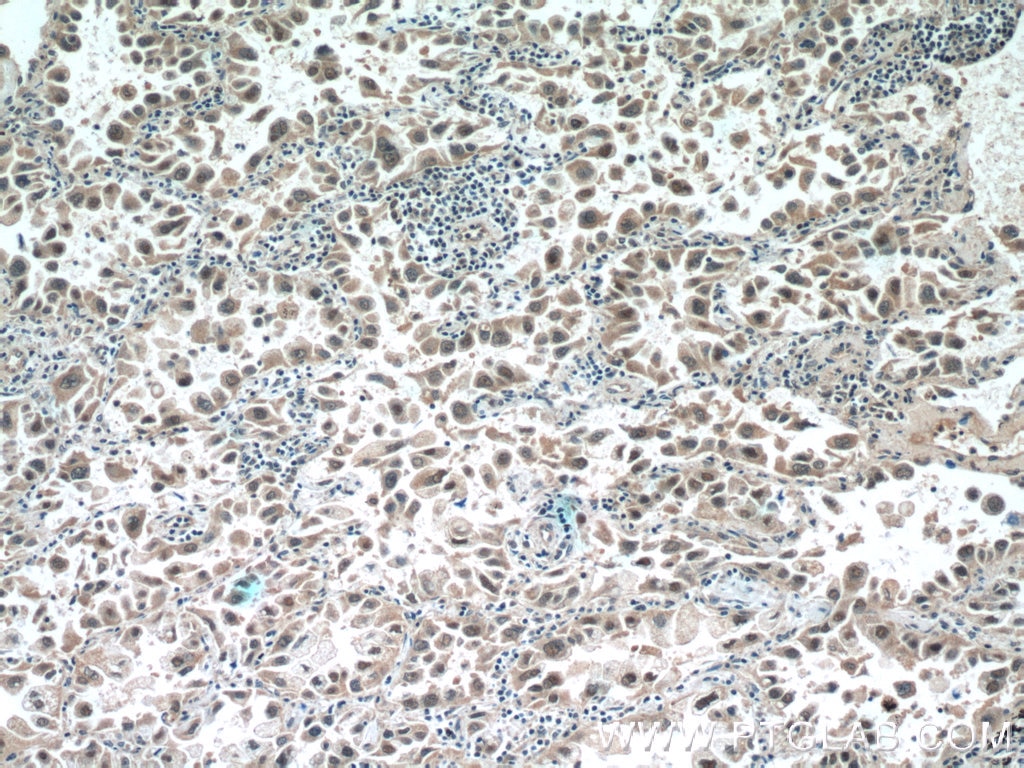 Immunohistochemistry (IHC) staining of human lung cancer tissue using SNRPD3 Polyclonal antibody (10379-1-AP)
