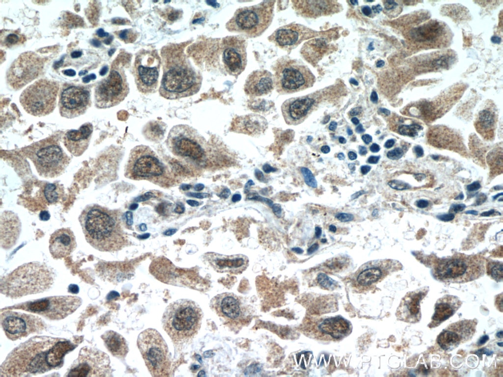 Immunohistochemistry (IHC) staining of human lung cancer tissue using SNRPD3 Polyclonal antibody (10379-1-AP)