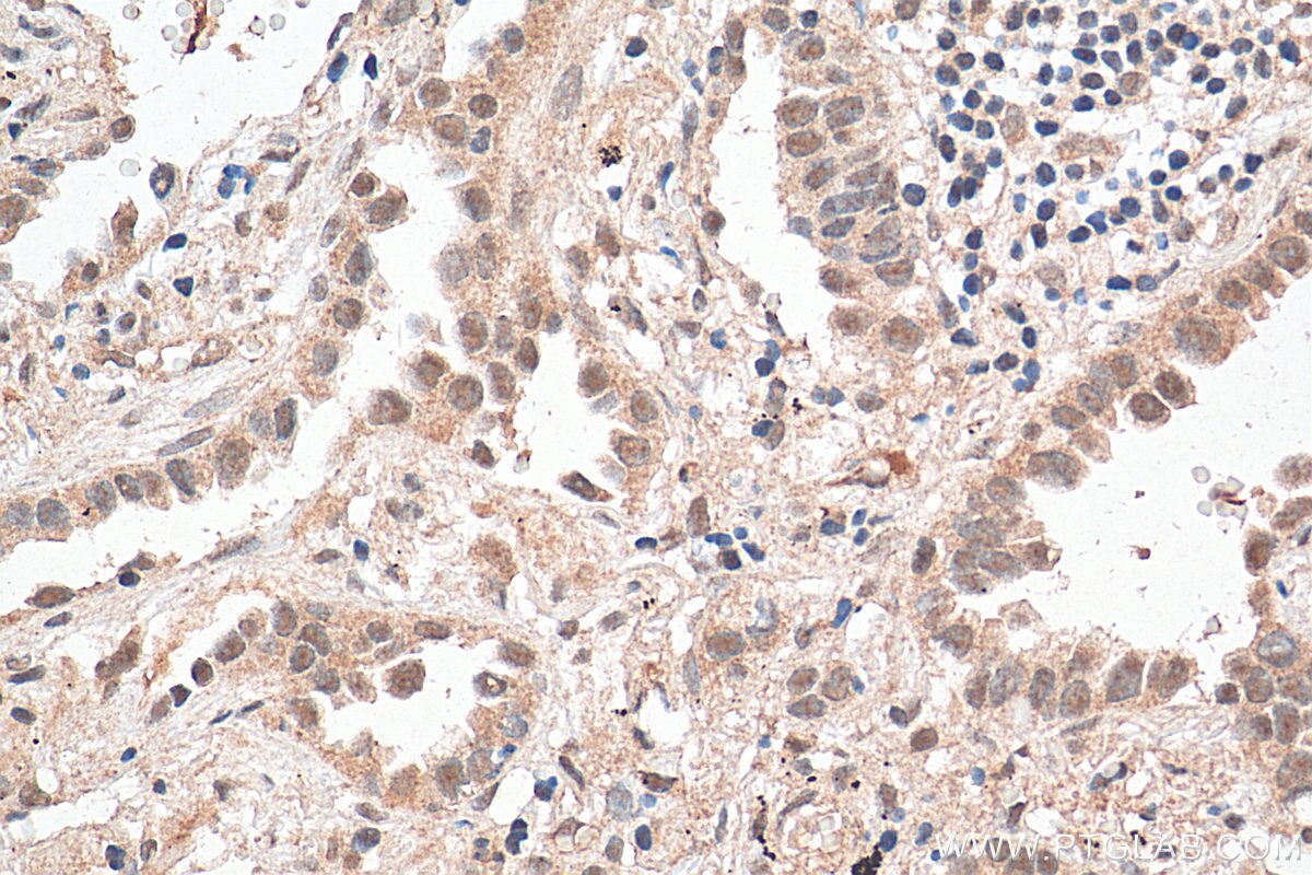 Immunohistochemistry (IHC) staining of human lung cancer tissue using SNRPD3 Polyclonal antibody (10379-1-AP)