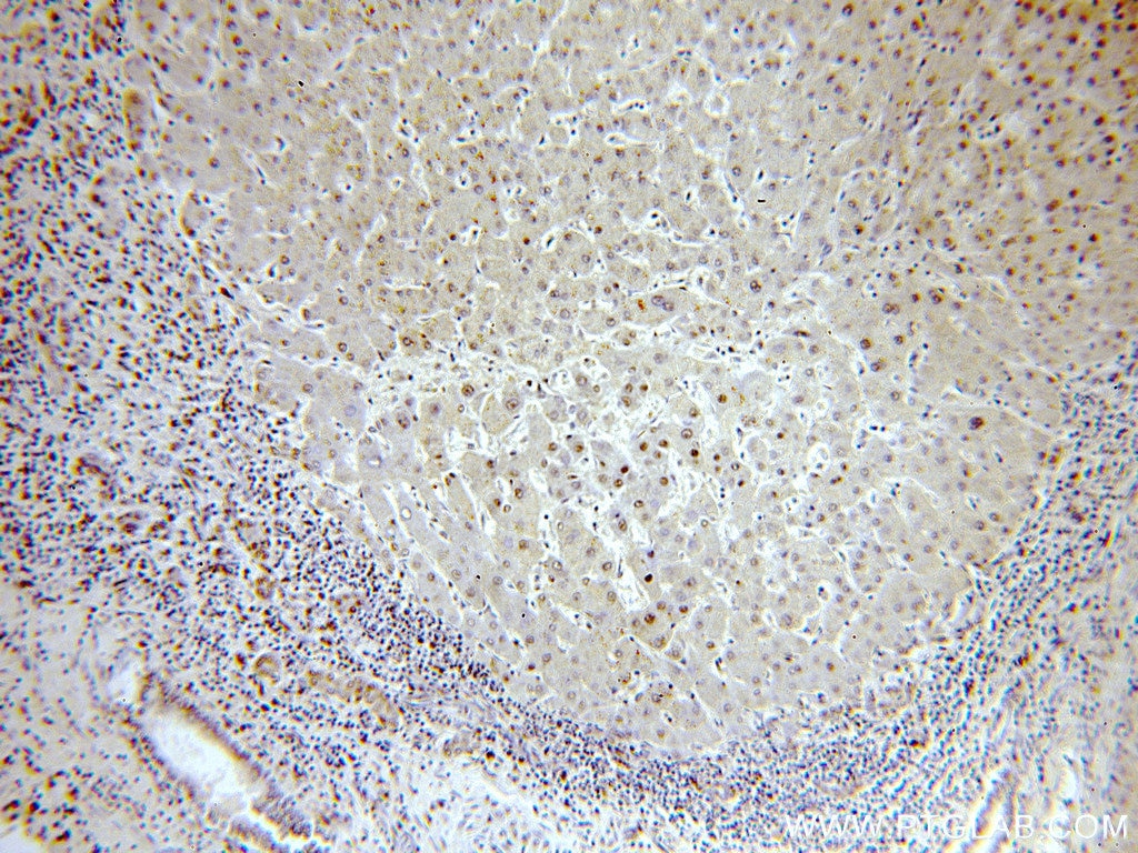 Immunohistochemistry (IHC) staining of human hepatocirrhosis tissue using SNRPE Polyclonal antibody (20407-1-AP)