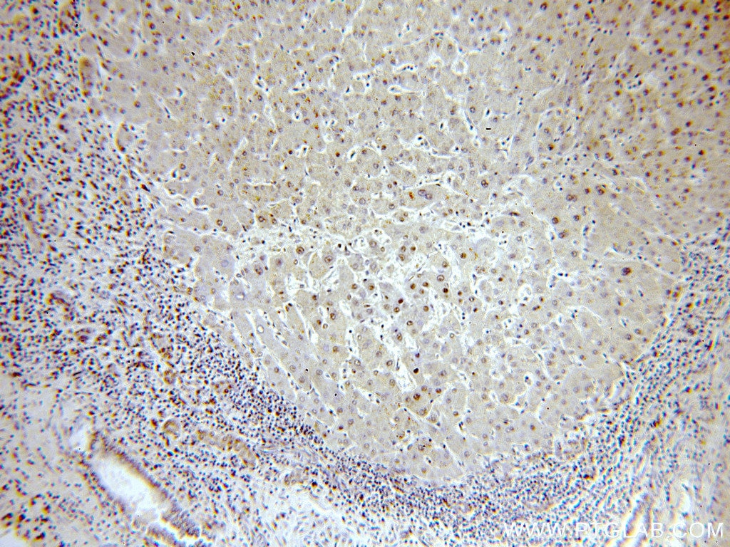 IHC staining of human hepatocirrhosis using 20407-1-AP