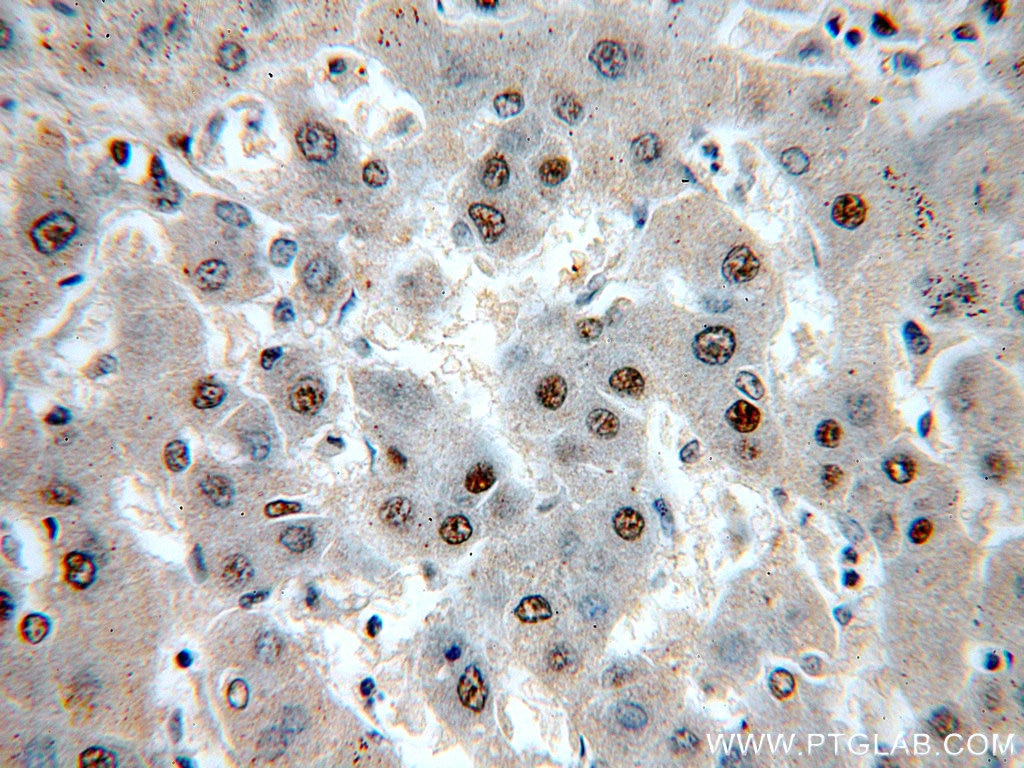 Immunohistochemistry (IHC) staining of human hepatocirrhosis tissue using SNRPE Polyclonal antibody (20407-1-AP)