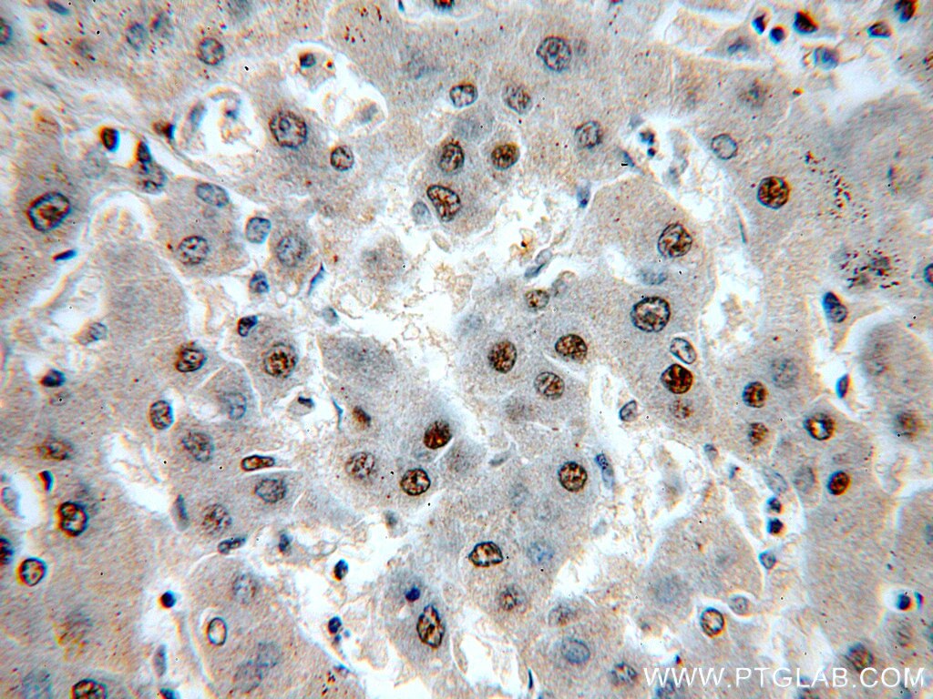 IHC staining of human hepatocirrhosis using 20407-1-AP