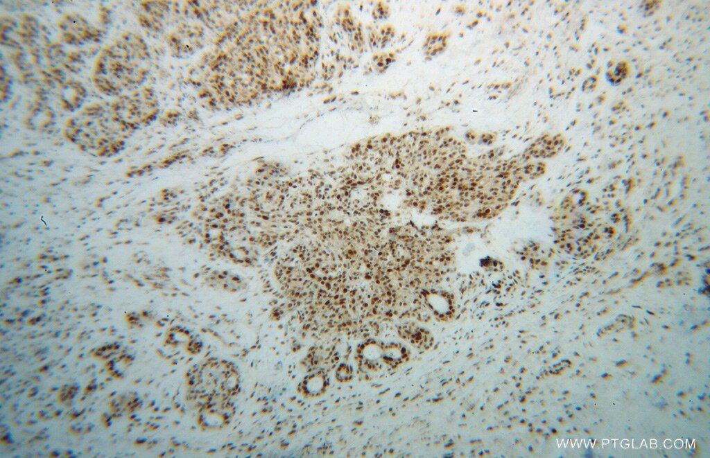 Immunohistochemistry (IHC) staining of human breast cancer tissue using SNRPF Polyclonal antibody (14977-1-AP)