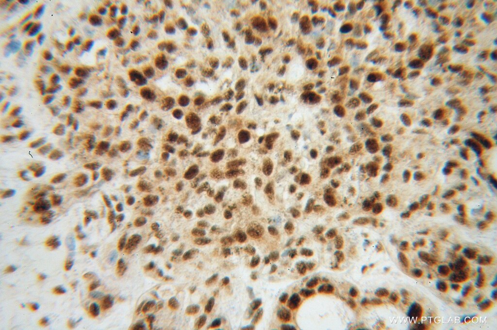 Immunohistochemistry (IHC) staining of human breast cancer tissue using SNRPF Polyclonal antibody (14977-1-AP)
