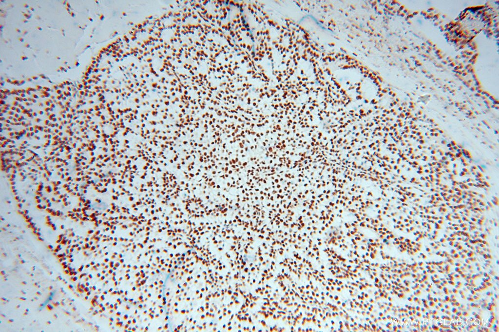 Immunohistochemistry (IHC) staining of human breast cancer tissue using SNRPF Polyclonal antibody (14977-1-AP)