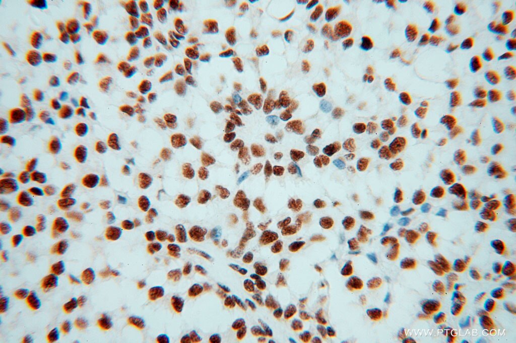 Immunohistochemistry (IHC) staining of human breast cancer tissue using SNRPF Polyclonal antibody (14977-1-AP)