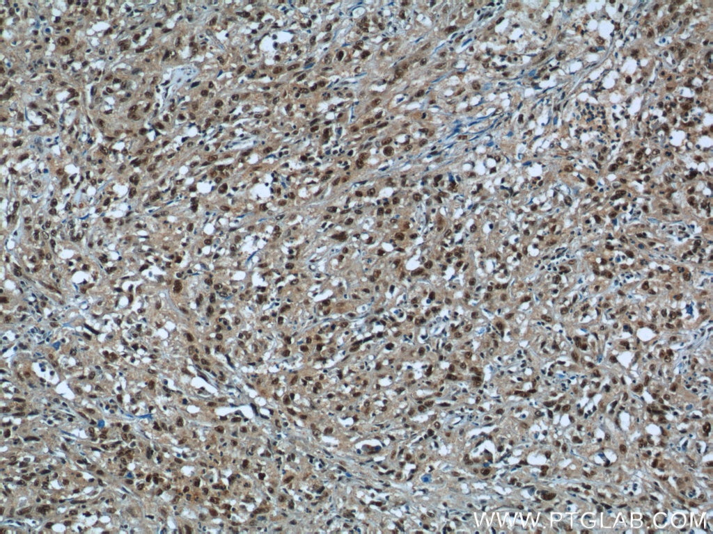 Immunohistochemistry (IHC) staining of human cervical cancer tissue using SNRPG Polyclonal antibody (15084-1-AP)