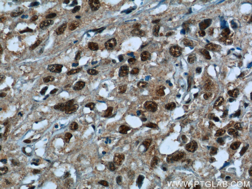 Immunohistochemistry (IHC) staining of human cervical cancer tissue using SNRPG Polyclonal antibody (15084-1-AP)