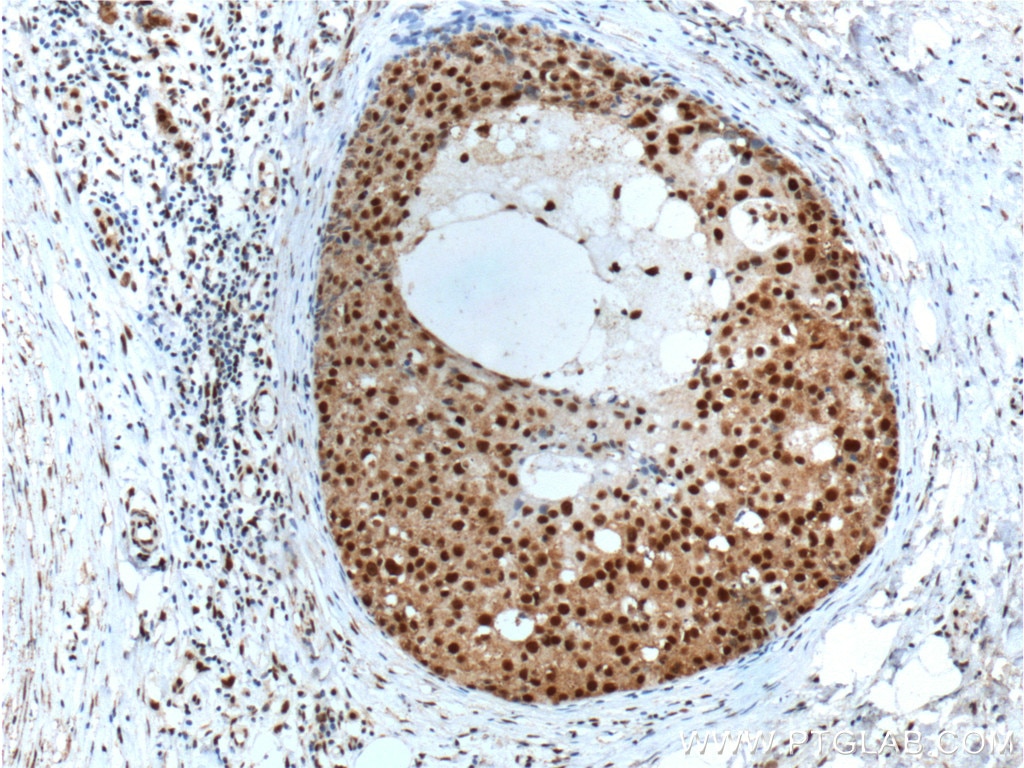 Immunohistochemistry (IHC) staining of human breast cancer tissue using SNRPG Polyclonal antibody (15084-1-AP)