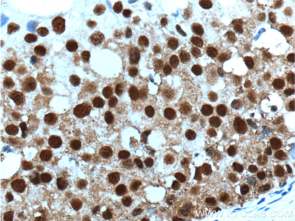 Immunohistochemistry (IHC) staining of human breast cancer tissue using SNRPG Polyclonal antibody (15084-1-AP)