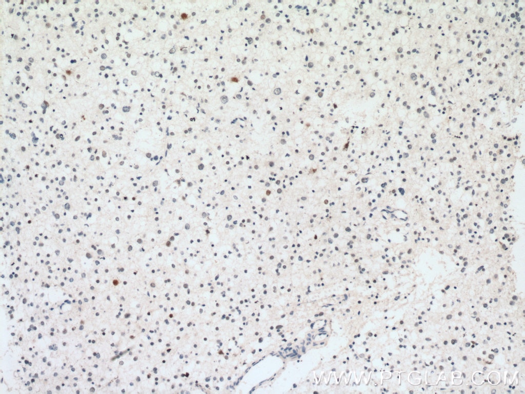 Immunohistochemistry (IHC) staining of human gliomas tissue using SNRPN Polyclonal antibody (11070-1-AP)