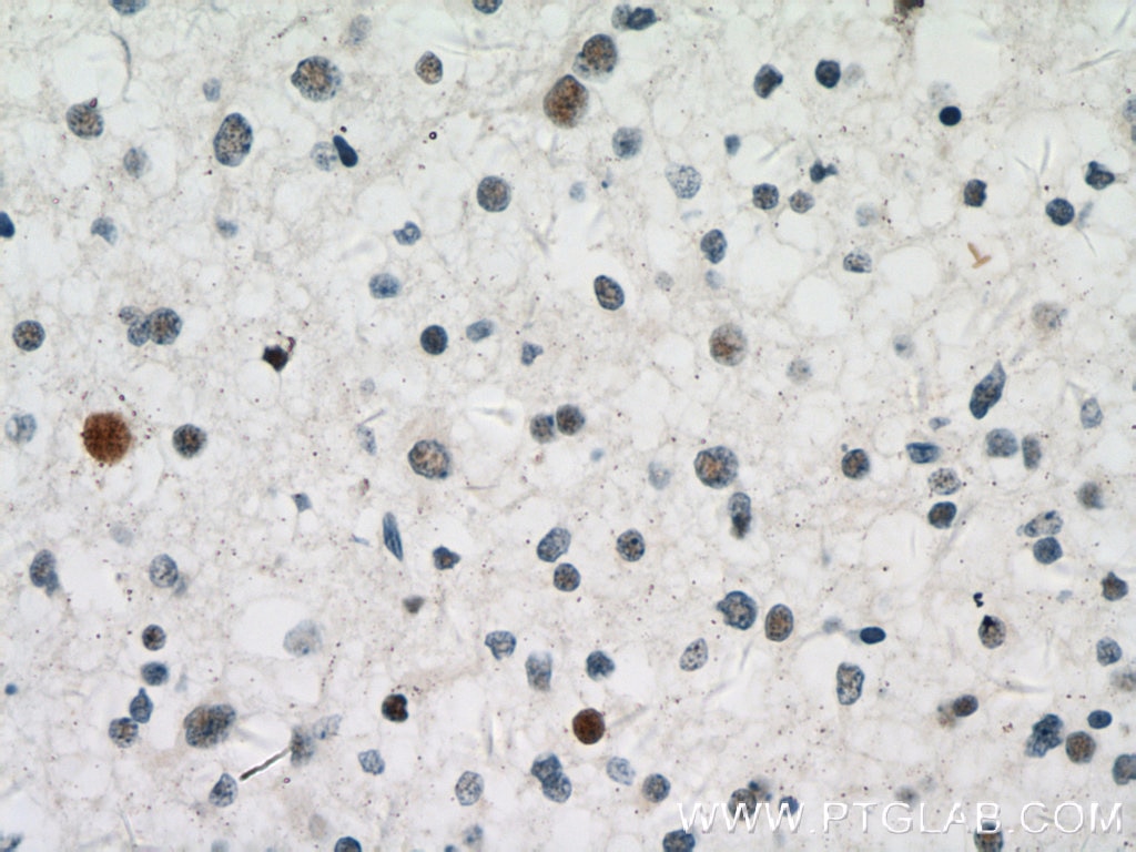 IHC staining of human gliomas using 11070-1-AP