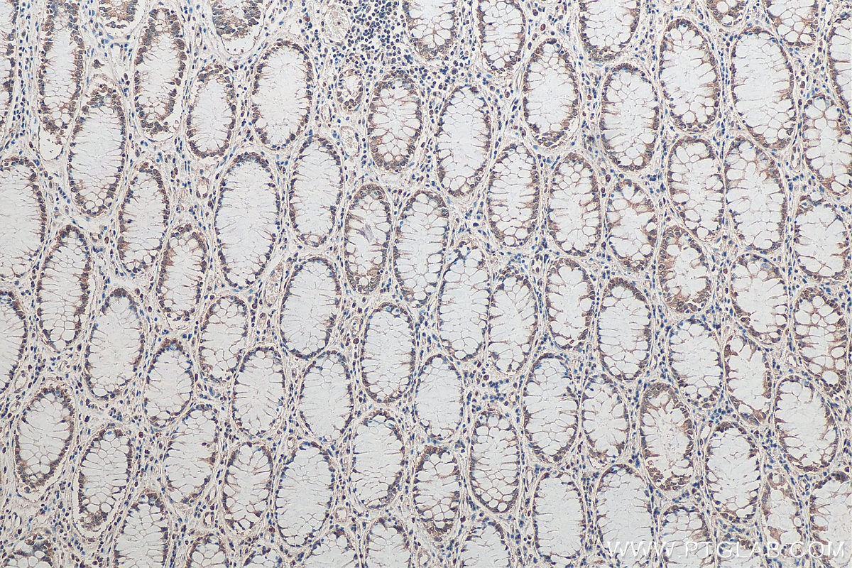 Immunohistochemistry (IHC) staining of human colon cancer tissue using SNRPN/SNRPB Monoclonal antibody (67280-1-Ig)