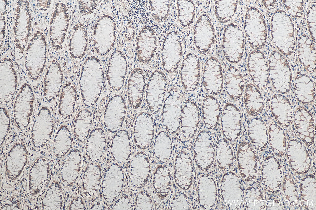 IHC staining of human colon cancer using 67280-1-Ig