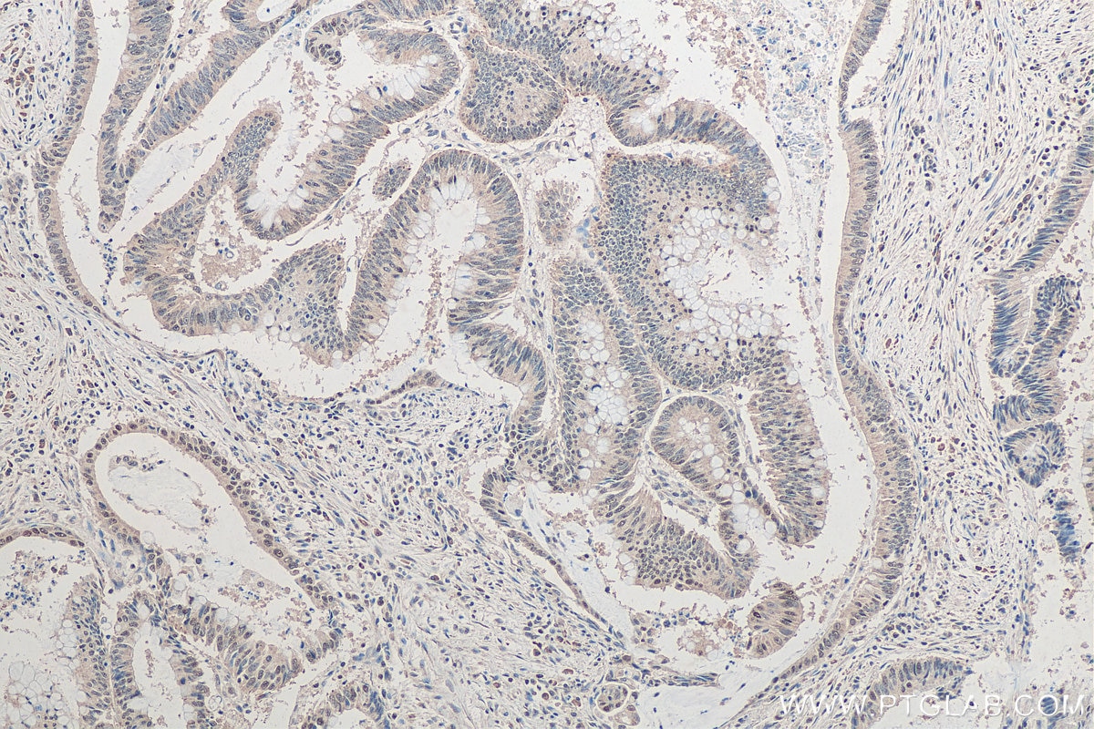 Immunohistochemistry (IHC) staining of human colon cancer tissue using SNRPN/SNRPB Monoclonal antibody (67280-1-Ig)