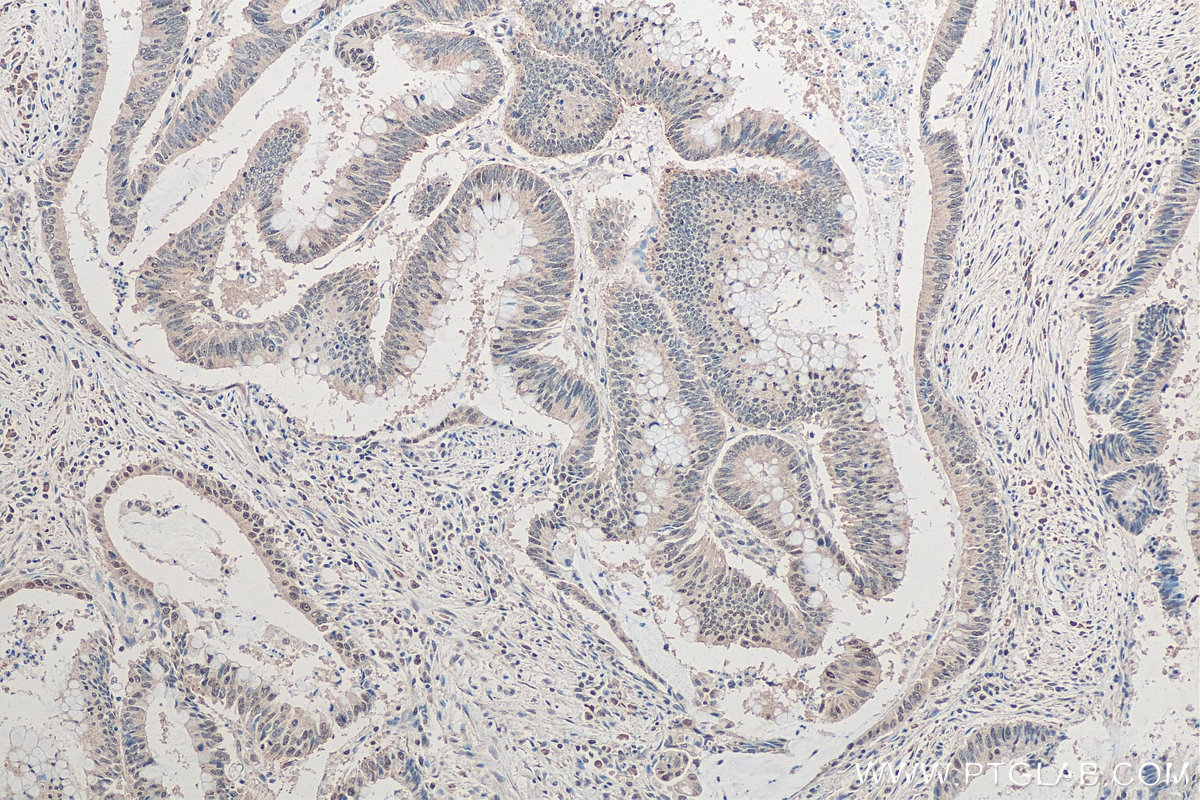 Immunohistochemistry (IHC) staining of human colon cancer tissue using SNRPN Monoclonal antibody (67280-1-Ig)