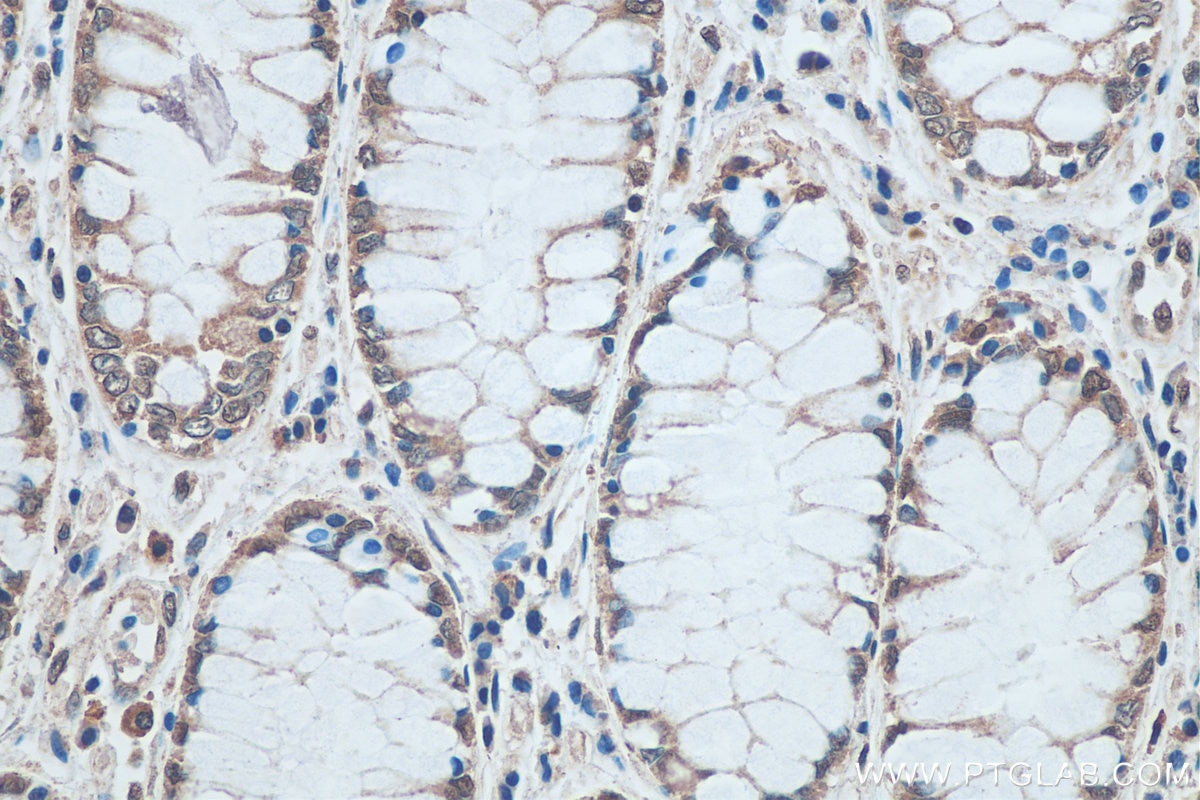 Immunohistochemistry (IHC) staining of human colon cancer tissue using SNRPN Monoclonal antibody (67280-1-Ig)