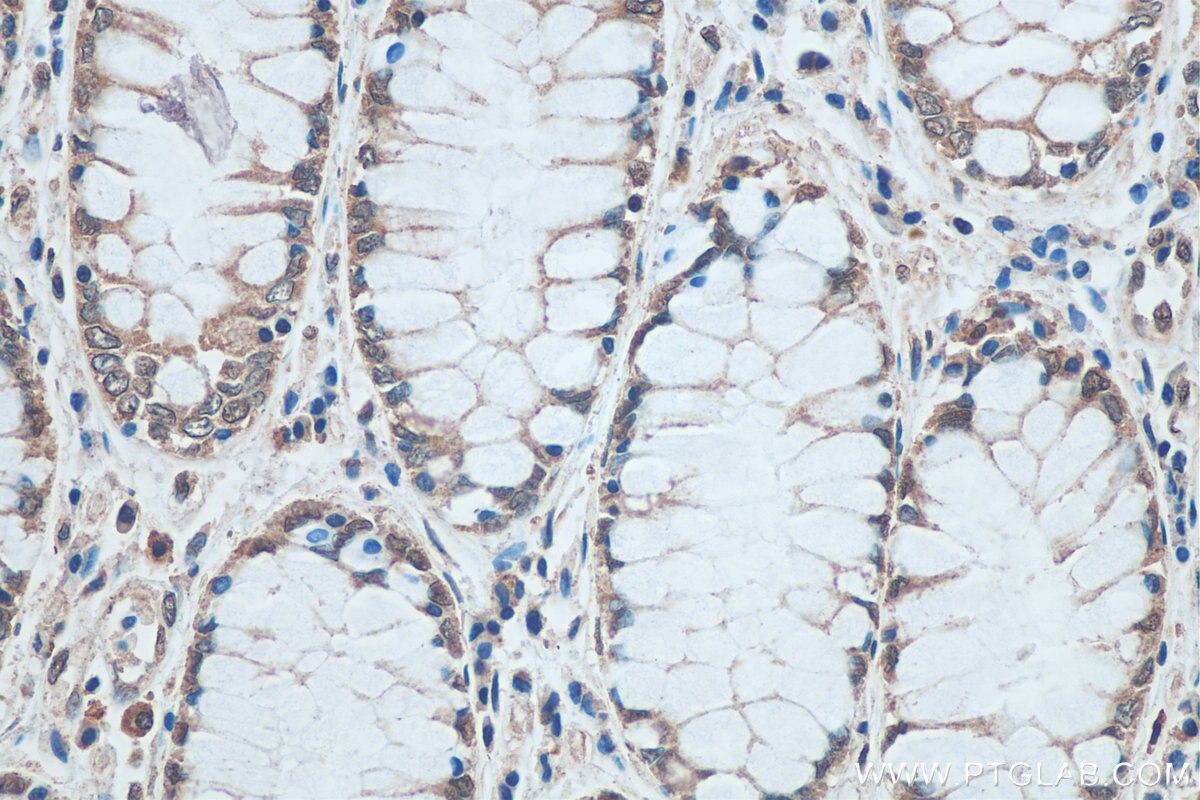 Immunohistochemistry (IHC) staining of human colon cancer tissue using SNRPN/SNRPB Monoclonal antibody (67280-1-Ig)
