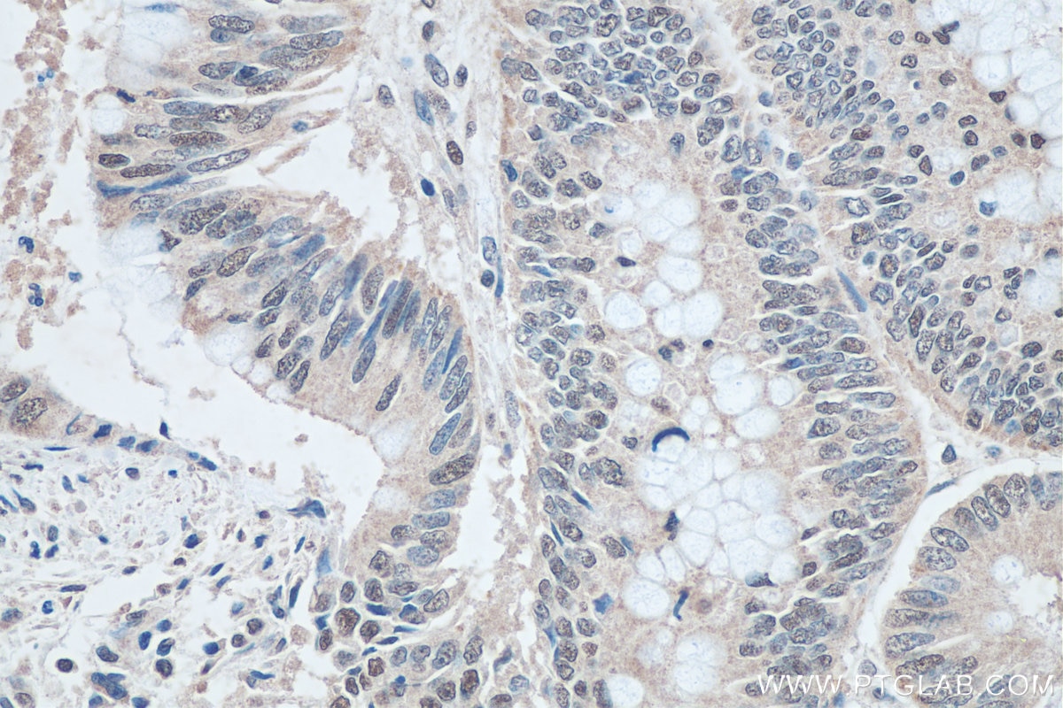 Immunohistochemistry (IHC) staining of human colon cancer tissue using SNRPN/SNRPB Monoclonal antibody (67280-1-Ig)