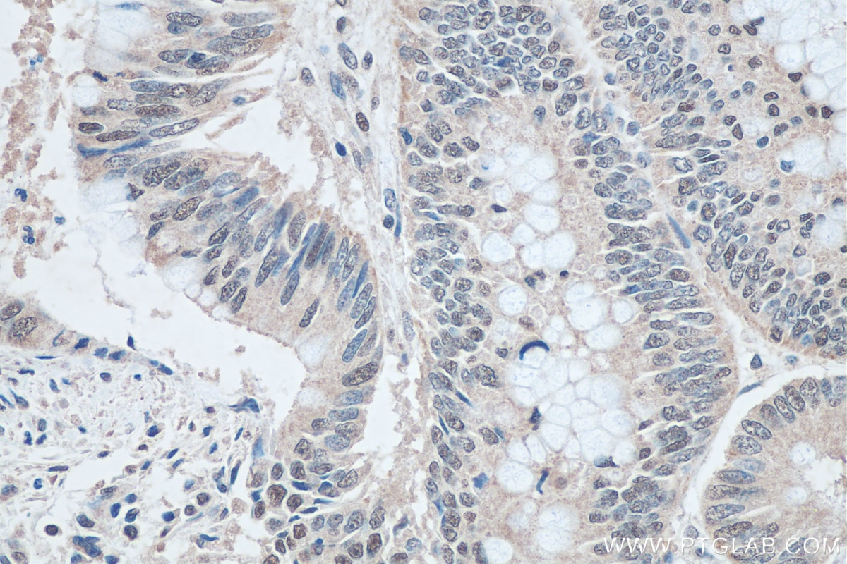 Immunohistochemistry (IHC) staining of human colon cancer tissue using SNRPN Monoclonal antibody (67280-1-Ig)