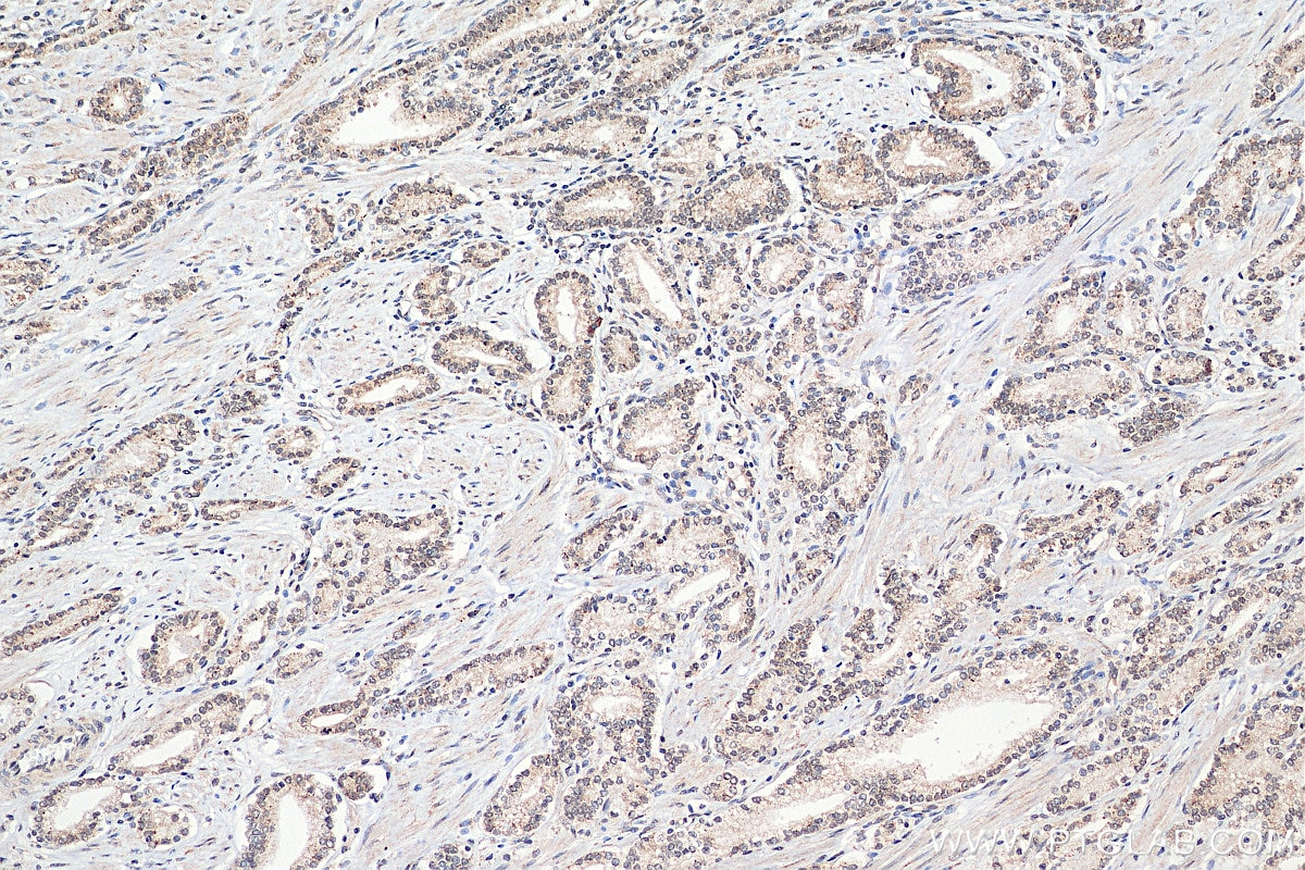 Immunohistochemistry (IHC) staining of human prostate cancer tissue using SNW1 Polyclonal antibody (25926-1-AP)