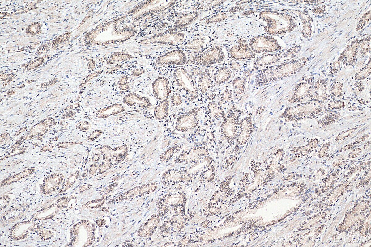 Immunohistochemistry (IHC) staining of human prostate cancer tissue using SNW1 Polyclonal antibody (25926-1-AP)