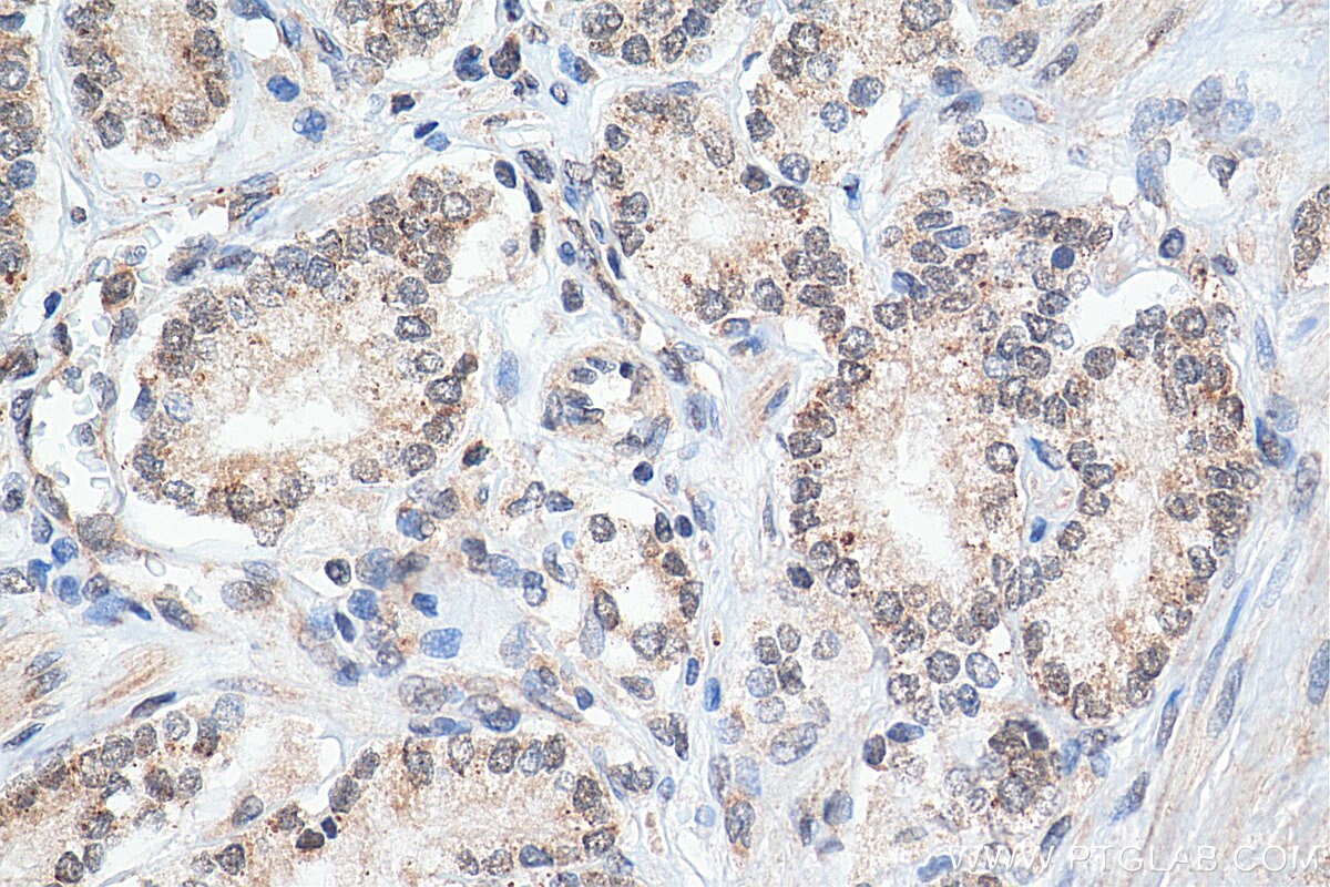 Immunohistochemistry (IHC) staining of human prostate cancer tissue using SNW1 Polyclonal antibody (25926-1-AP)