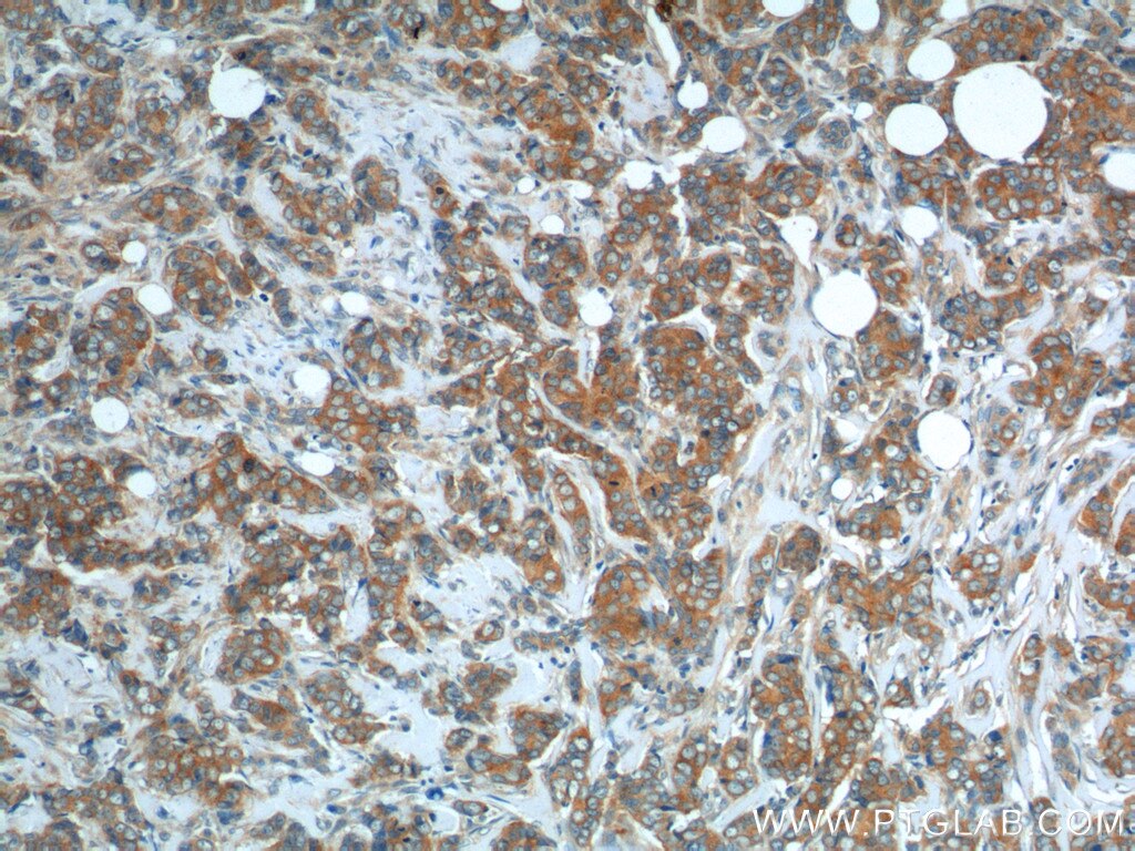 Immunohistochemistry (IHC) staining of human breast cancer tissue using SNX1 Polyclonal antibody (10304-1-AP)