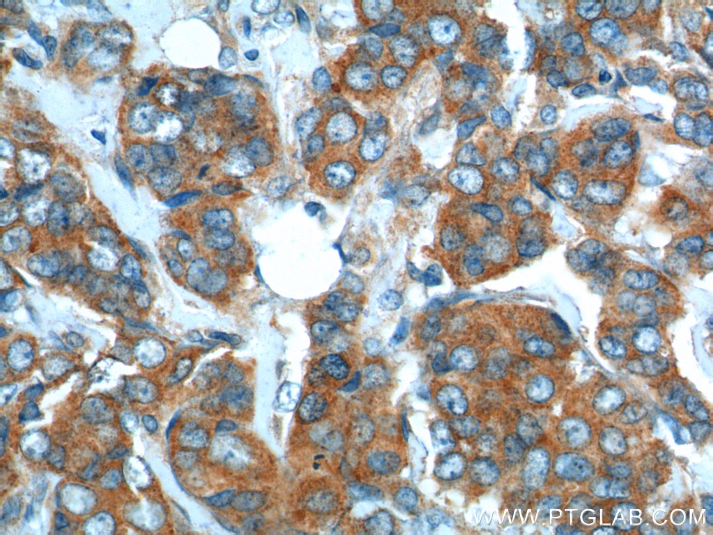 Immunohistochemistry (IHC) staining of human breast cancer tissue using SNX1 Polyclonal antibody (10304-1-AP)