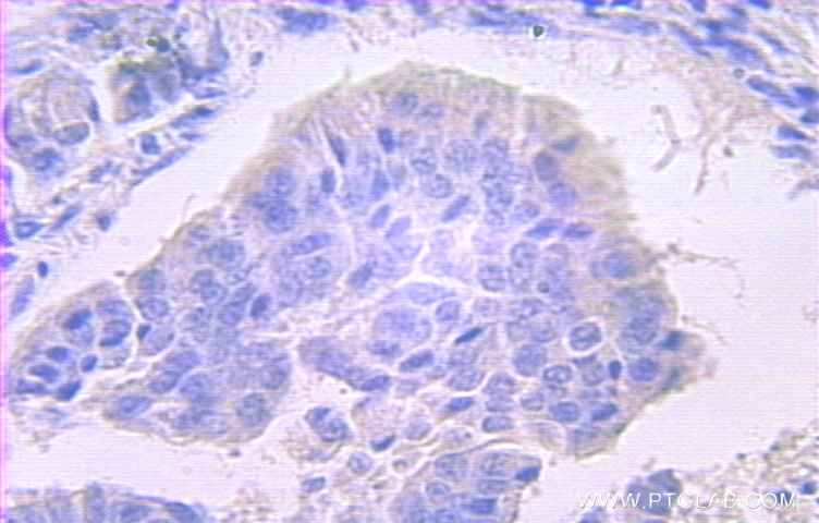 IHC staining of human pancreas cancer using 10304-1-AP