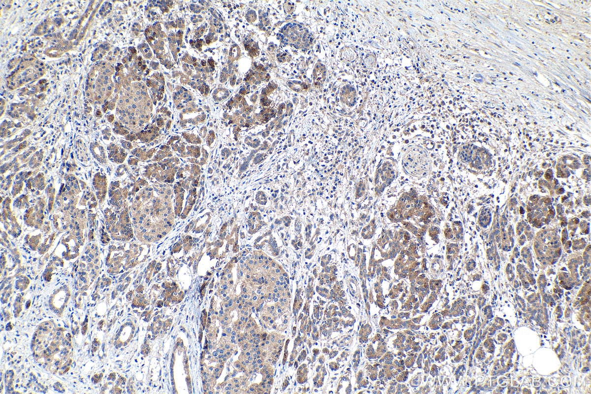IHC staining of human pancreas cancer using 26727-1-AP