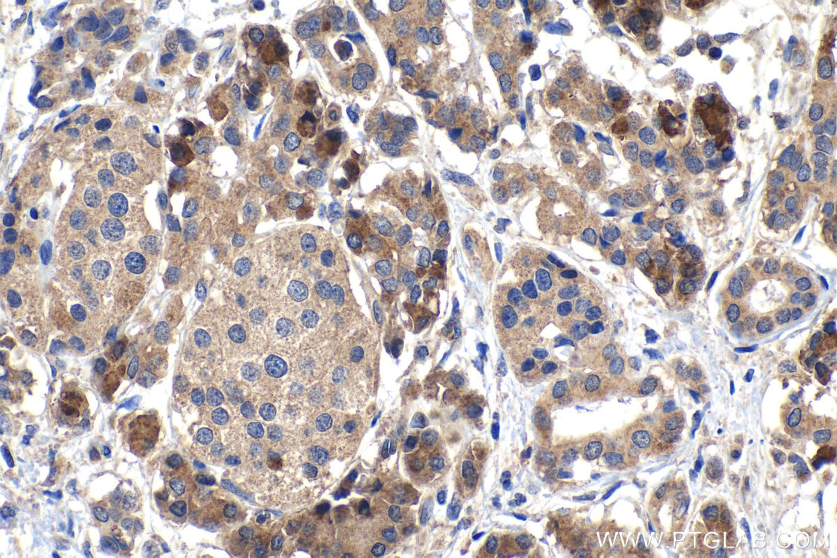 Immunohistochemistry (IHC) staining of human pancreas cancer tissue using SNX10 Polyclonal antibody (26727-1-AP)