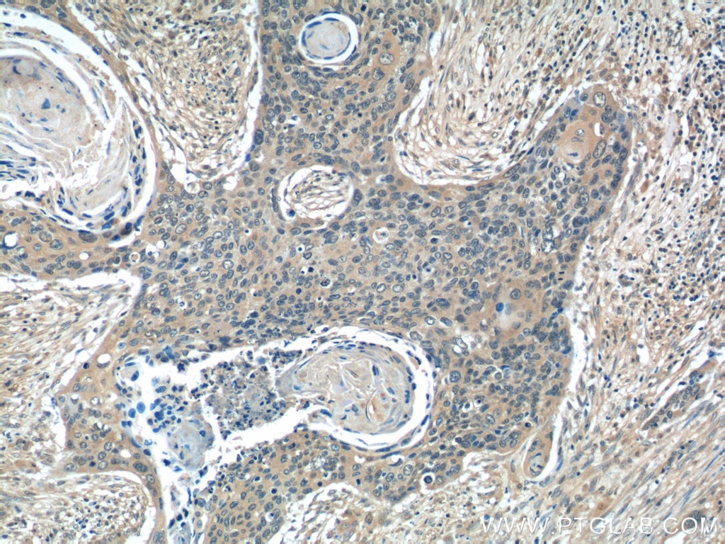 Immunohistochemistry (IHC) staining of human cervical cancer tissue using SNX27 Polyclonal antibody (16329-1-AP)