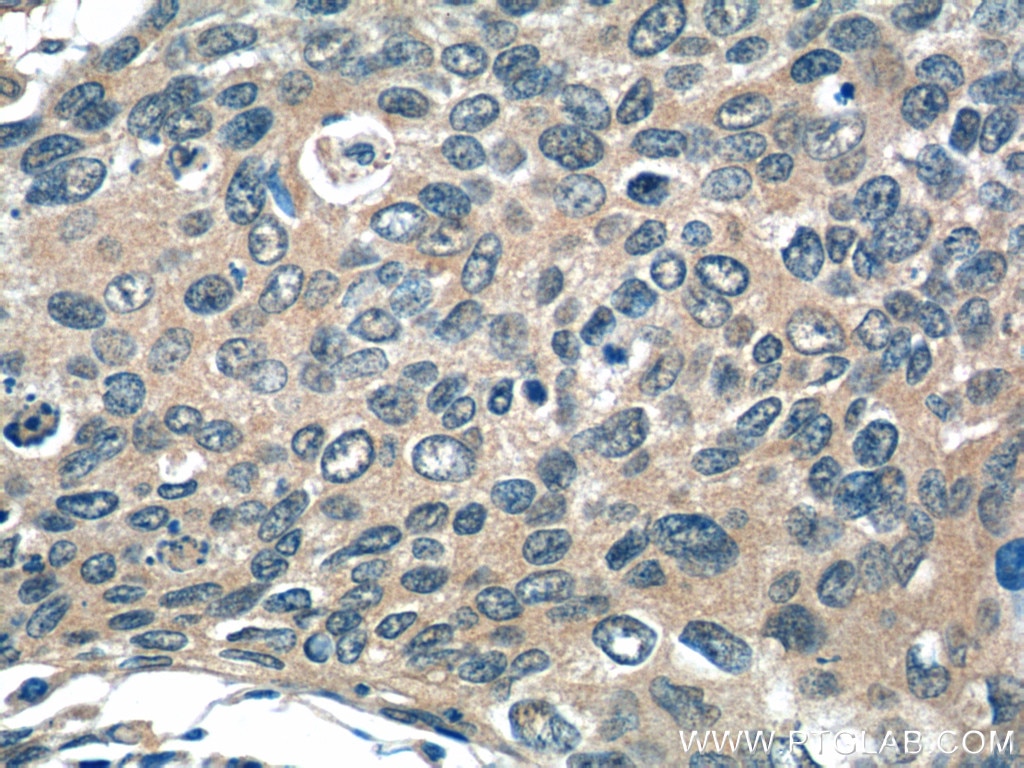 Immunohistochemistry (IHC) staining of human cervical cancer tissue using SNX27 Polyclonal antibody (16329-1-AP)