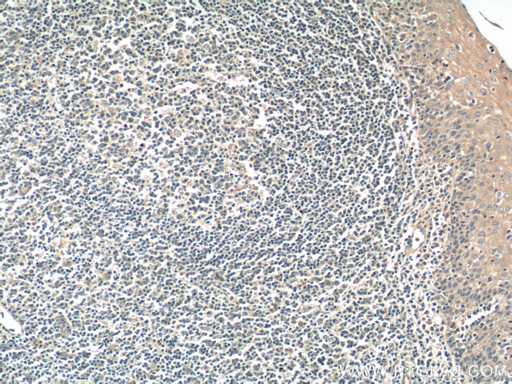 Immunohistochemistry (IHC) staining of human tonsillitis tissue using SNX27 Polyclonal antibody (16329-1-AP)