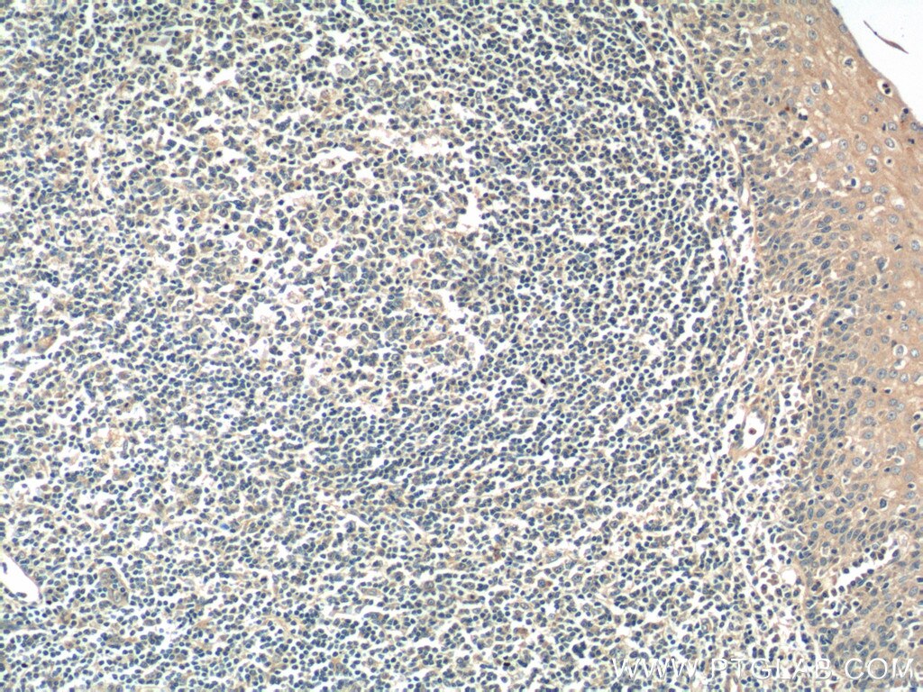 IHC staining of human tonsillitis using 16329-1-AP