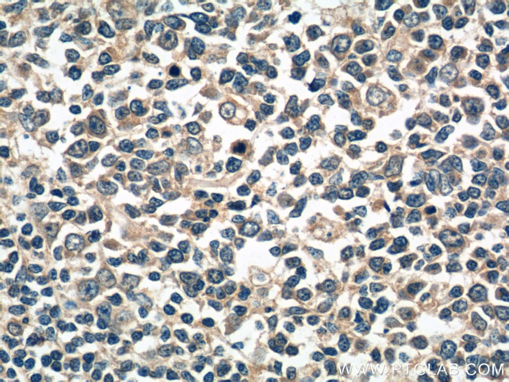 Immunohistochemistry (IHC) staining of human tonsillitis tissue using SNX27 Polyclonal antibody (16329-1-AP)