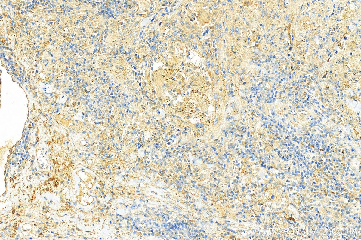 Immunohistochemistry (IHC) staining of human skin cancer tissue using SNX3 Polyclonal antibody (10772-1-AP)