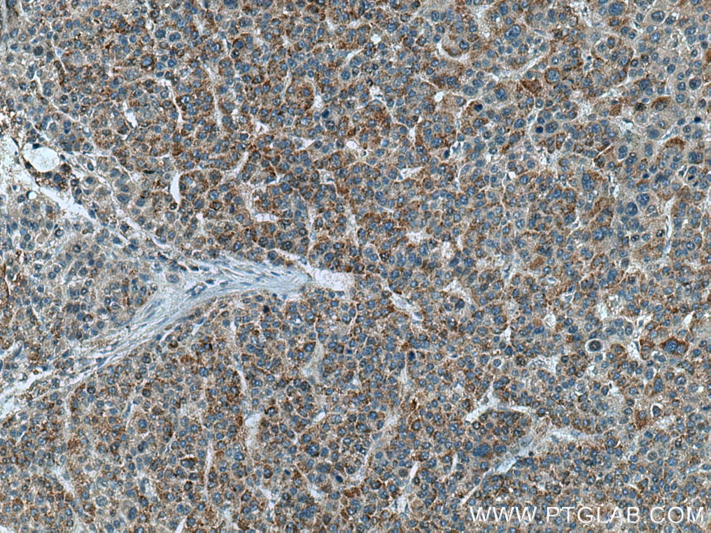 Immunohistochemistry (IHC) staining of human liver cancer tissue using SNX5 Monoclonal antibody (67665-1-Ig)