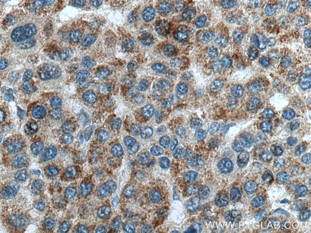 Immunohistochemistry (IHC) staining of human liver cancer tissue using SNX5 Monoclonal antibody (67665-1-Ig)