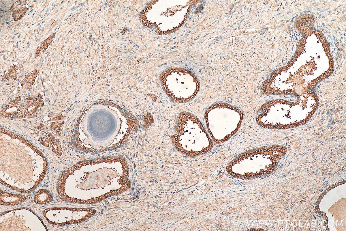 IHC staining of human prostate cancer using 10114-1-AP