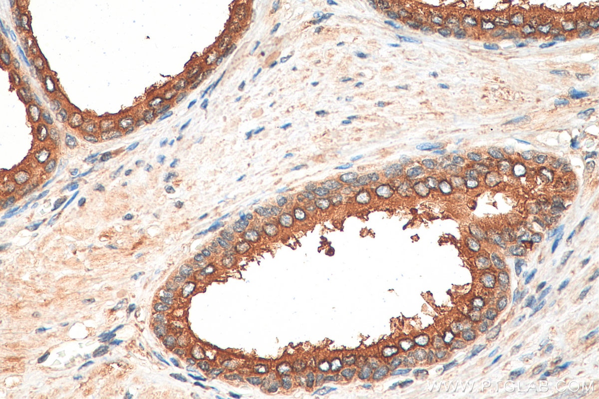 Immunohistochemistry (IHC) staining of human prostate cancer tissue using SNX6 Polyclonal antibody (10114-1-AP)
