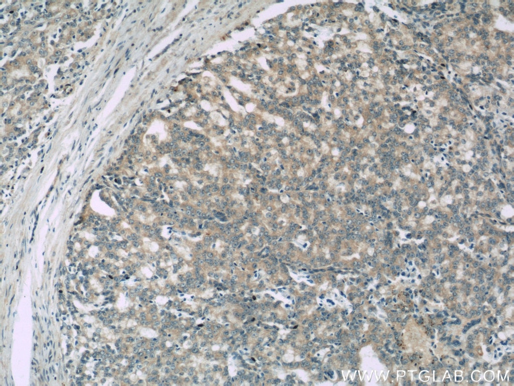 Immunohistochemistry (IHC) staining of human prostate cancer tissue using SNX6 Polyclonal antibody (10114-1-AP)