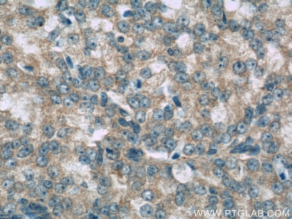 Immunohistochemistry (IHC) staining of human prostate cancer tissue using SNX6 Polyclonal antibody (10114-1-AP)