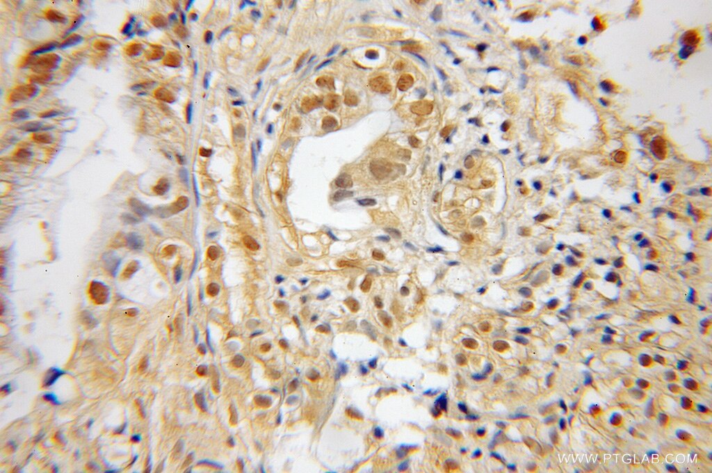 Immunohistochemistry (IHC) staining of human pancreas cancer tissue using SNX7 Polyclonal antibody (12269-1-AP)