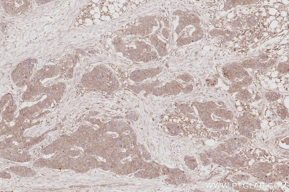 Immunohistochemistry (IHC) staining of human stomach cancer tissue using SNX9 Polyclonal antibody (15721-1-AP)