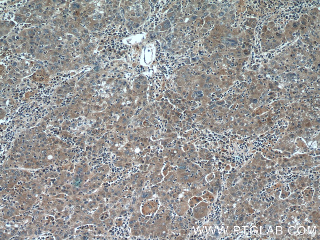 Immunohistochemistry (IHC) staining of human liver cancer tissue using SOCS1 Polyclonal antibody (25286-1-AP)