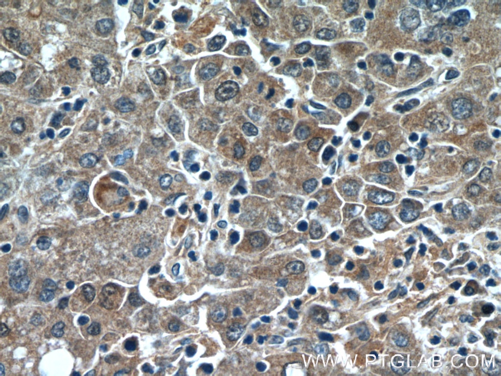 Immunohistochemistry (IHC) staining of human liver cancer tissue using SOCS1 Polyclonal antibody (25286-1-AP)