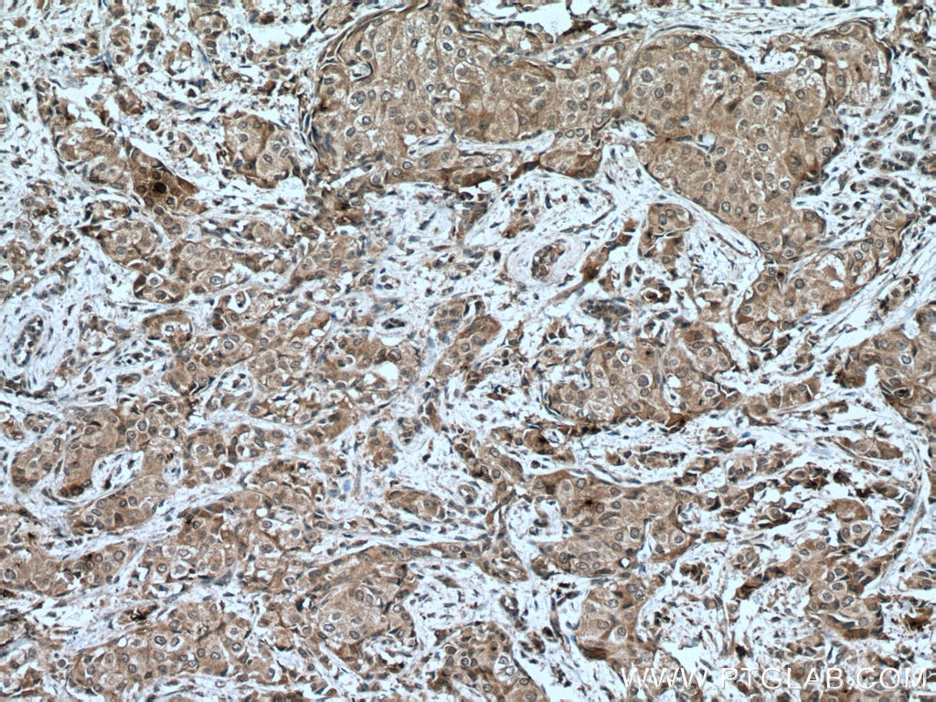Immunohistochemistry (IHC) staining of human breast cancer tissue using SOCS3 Monoclonal antibody (66797-1-Ig)